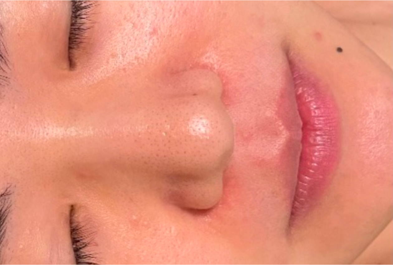 小氣泡潔淨療程 Aqua Peel