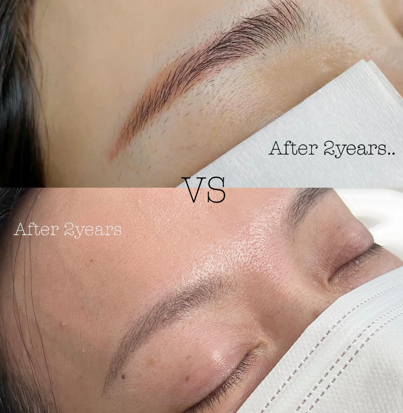 真正韓式激光洗眉 Laser Removal